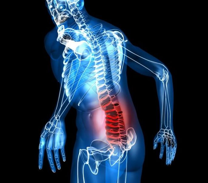stupeň a vývojové fáze bederní osteochondózy