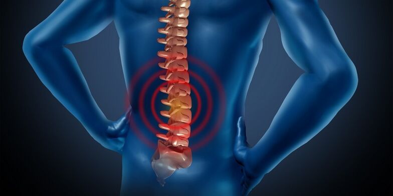 Osteochondrosis bederní oblasti