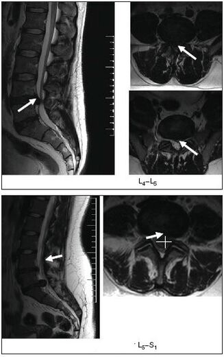 MRI Obrázek herniovaného disku v páteři