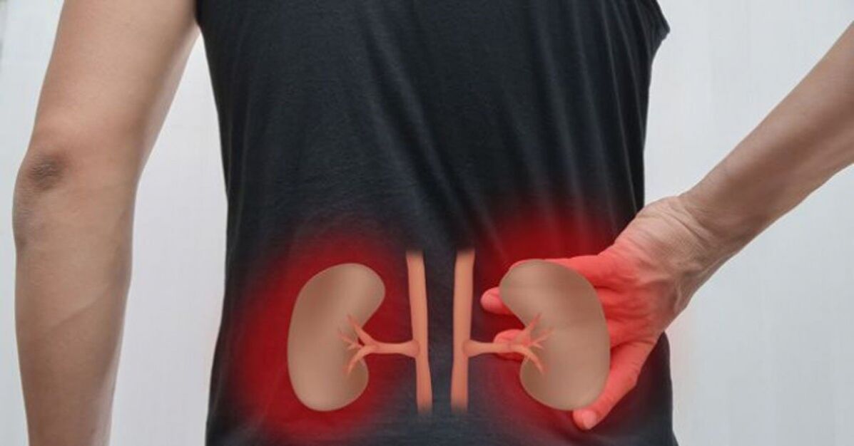 Zánět ledvin může způsobit bolesti dolní části zad