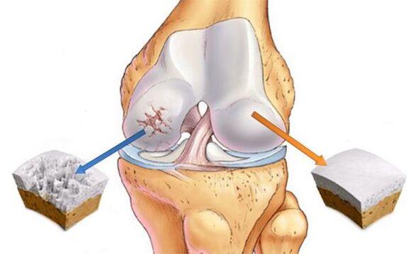 Osteoartróza kolenního kloubu (vlevo) a normální chrupavky (vpravo)