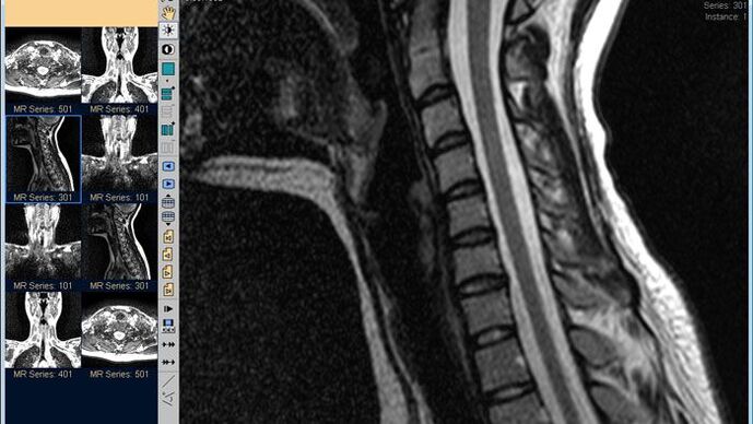 MRI krční páteře je nejlepší metodou pro diagnostiku bolesti krku