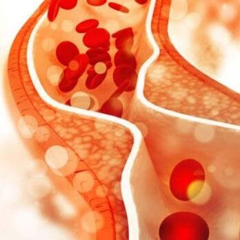 Usazování cholesterolu na vnitřních stěnách cév vyvolává bolest na straně krku